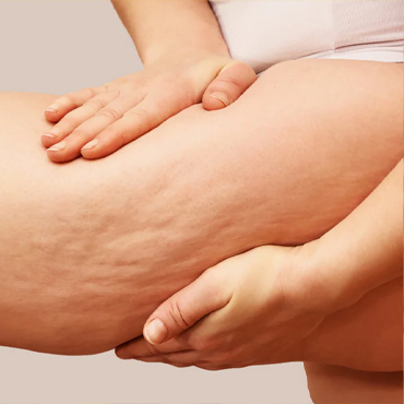 CELLULITE - DIURESI